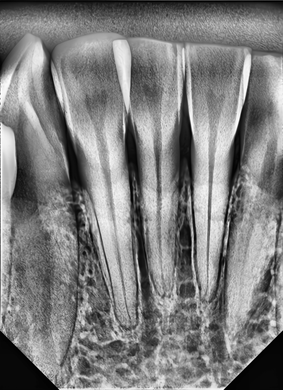 Periapical X-ray — anterior teeth captured with XRD Imagen sensor