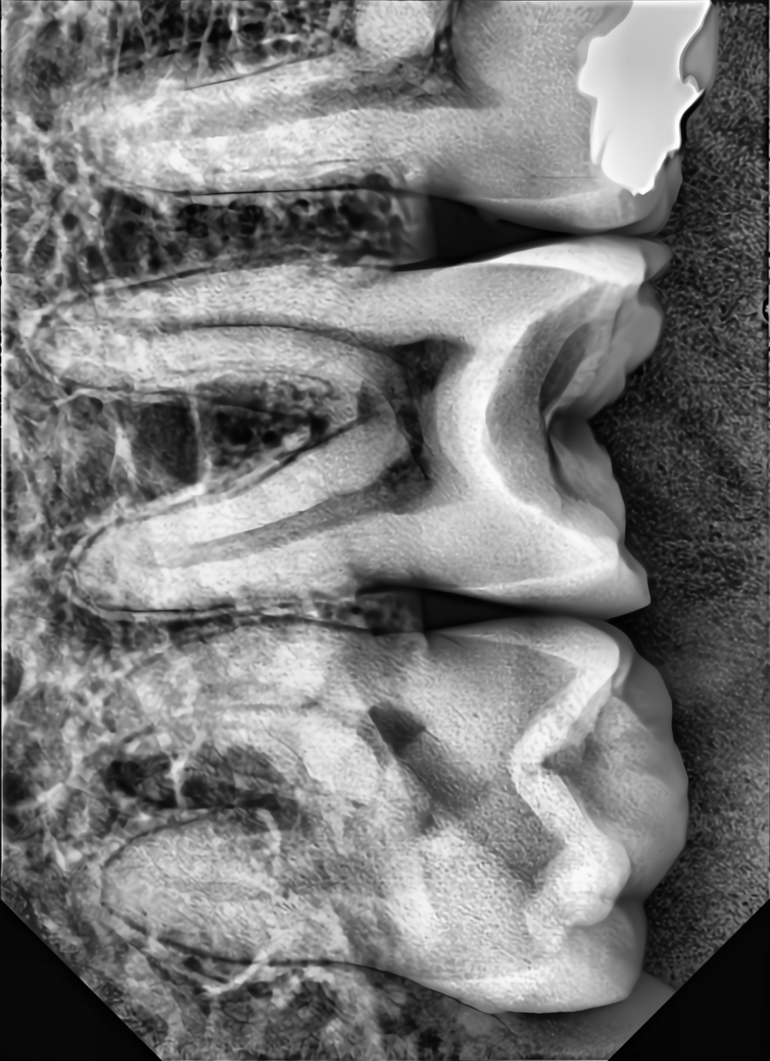Periapical X-ray — molar region captured with XRD Imagen sensor